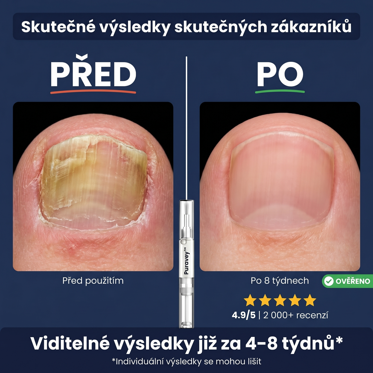 Puravey™ Antimykotické Pero — Zbavte se plísně nehtů jednou provždy (Bez bolesti. Bez zápachu. Bez skrývání.)